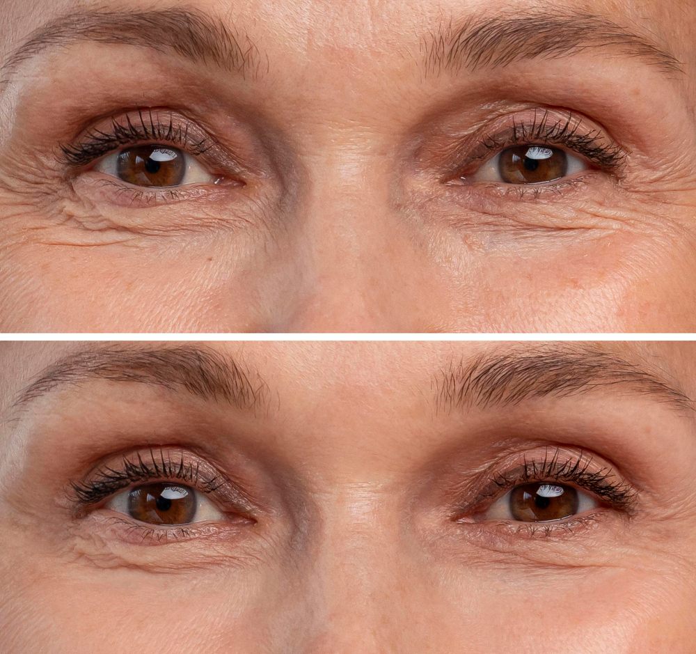 Upper Blepharoplasty